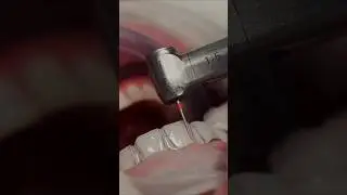 Composite veneers. Front teeth restoration. Full video from channel #dentist