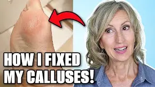 How I Got Rid of Stubborn Foot Calluses & Cracks | Over 50