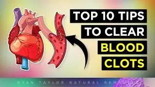 10 Tips To Clear Blood Clots (Naturally)