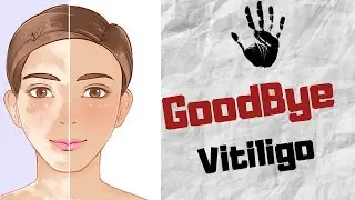 The Natural Vitiligo Treatment System TM ~SPECIAL OFFER~ With 3 Months FREE Consultations