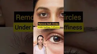 Remove Dark Circles & Puffy Eyes Fast! #darkcircles #undereyebags  #eyebags #beautytips #skincare