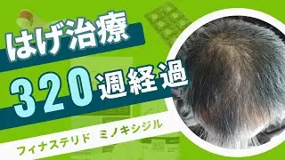 【はげ治療320週経過 】フィナステリドとミノキシジルで６年継続で生えてきてる！【あきらめないマイペースの薄毛治療】