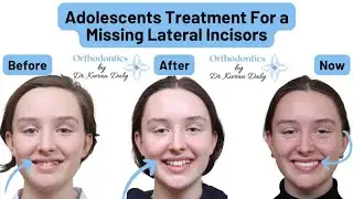 Substitution of Missing Lateral Incisors in Adolescent Patient