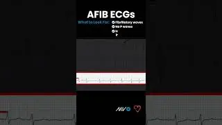 What to Look for in an AFib ECG