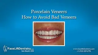 Porcelain Veneers -- How to Avoid Bad Veneers