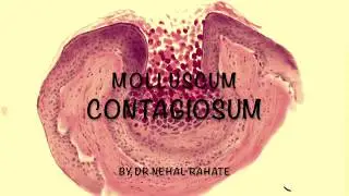 Molluscum contagiosum