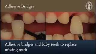 Adhesive bridges and baby teeth to replace missing teeth // Case of the Month