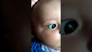 pimple in baby's head and face|| baby pimples|| red bumps in baby's head and face