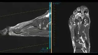 Pain in forefoot and toe from plantar plate tear