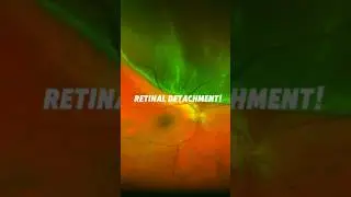 Retinal detachment is vision-threatening; caused by tears, treated with laser or surgery.