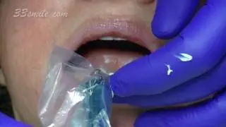 Video Procedure of Placing Dental Veneers on All Teeth at Cosmetic Dental Associates