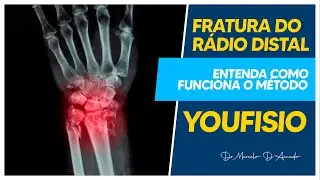 M&Eacute;TODO YOUFISIO | ENTENDA COMO FUNCIONA O PROGRAMA DE EXERC&Iacute;CIOS PARA FRATURA DO R&Aacute;DIO DISTAL.