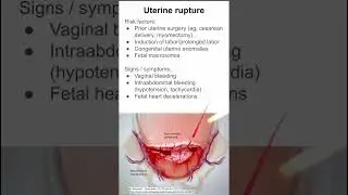 Uterine rupture
