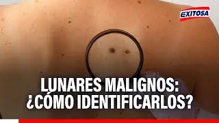 🔴🔵 Lunares malignos: ¿Cómo identificarlos?