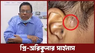 প্রি-অরিকুলার সাইনাস। Preauricular sinus। Prof. Dr. Md. Abu Hanif