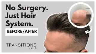 Natural results. Zero surgery. This is what modern men&rsquo;s hair replacement actually looks like.