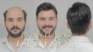 PROTEZ SA&Ccedil; İLE İNANILMAZ DEĞİŞİM! - Hair Replacement