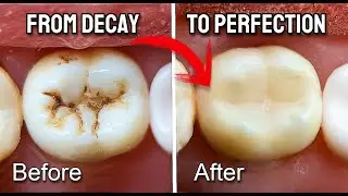 Precision Molar Restoration | Stamp Technique for Pit and Fissure Caries