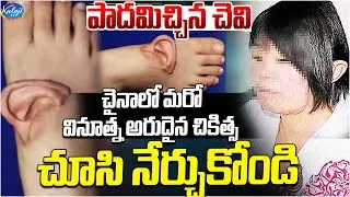 పాదమిచ్చిన చెవి.. | చూసి నేర్చుకోండి.. | Rare Innovative Medical Treatment from China | Kaloji TV