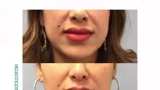 Kybella Buccal Fat