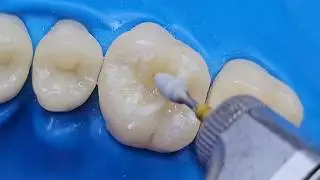 Satisfying Tooth Filling - Watch This Perfect Restoration !