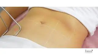 Fotona TightSculpting