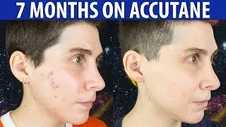 Accutane for Persistent Mild Acne &mdash; 7 Month Update