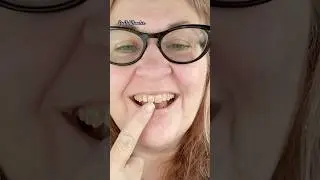 I Chipped My TOOTH! Then Got It Fixed! | Amazing Modern Dentistry #seevalwander #dentalartistry