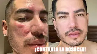TODO SOBRE ROSÁCEA | MI EXPERIENCIA Y RECOMENDACIONES | Pepe Gutiérrez
