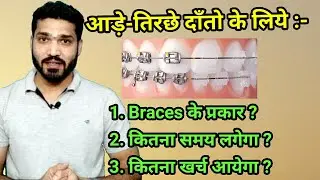 Braces lagwane ka time or kharch ? kitne prakar k hote hai braces?