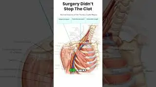 Thoracic Outlet Syndrome Failed Surgery Outcomes and Recurrence Explained