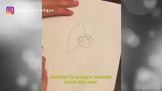 BARTHOLIN CYST MARSUP INSTAGRAM 02