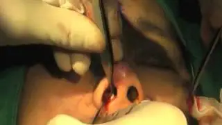 Bistool Implant - Paranasal Augmentation