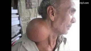 Interesting Case Of Lipoma - Types & Treatment