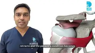 I wish I knew this before my Rotator Cuff Repair Surgery