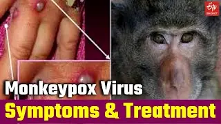 What is Monkeypox Virus? Know About The Symptoms and Treatment of Monkey Pox Virus | LNJP Hospital
