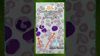 How do cancer cells look in the microscope? #knowledgesankul #labtechnician