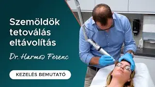 Szemöldök tetoválás eltávolítás - interjú és kezelés bemutató Dr. Harmos Ferenccel