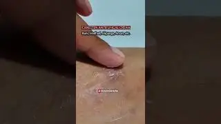 CANESTEN ANTIFUNGAL CREAM