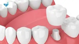 West Lake Hills Metal-Free Dental Crowns For Cracked Tooth Restoration, Same-Day Treatment