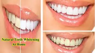 Natural Teeth Whitening At Home - How To Get Whiter Teeth