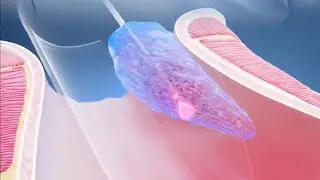 Why Most Hemorrhoid Treatments Fail? Discover Our Laser Solution with No Recurrence and No pain