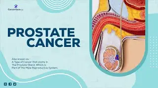 Understanding Prostate Cancer | The Most Common Male Cancer