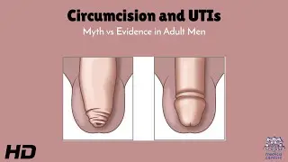 Circumcision and UTIs: Myth vs Evidence in Adult Men Explained