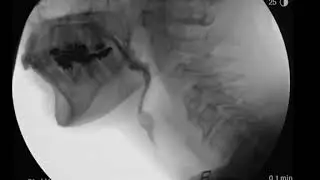 Why did she aspirate Part 2?
