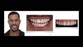 Simplified Esthetics to Advanced Ceramics, A Universal Ceramic System