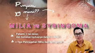 Bedakan Milia vs Syringoma Dalam 3 detik! | 3 Prinsip dasar Yang Wajib Diketahui, dr. Irfan Prasetya