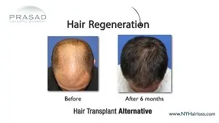 Hair Regeneration Non-Surgical Hair Transplant Alternative that Can Stop Further Hair Loss
