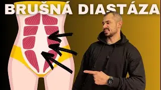 Cviky na brušnú diastázu – ako cvičiť bezpečne doma