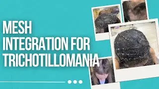 Why Mesh Integration is the PERFECT Solution for Trichotillomania